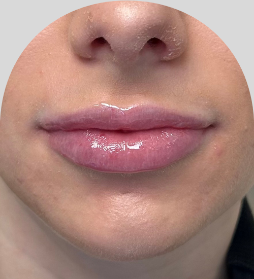 Lip Fillers - Case 53203 - After