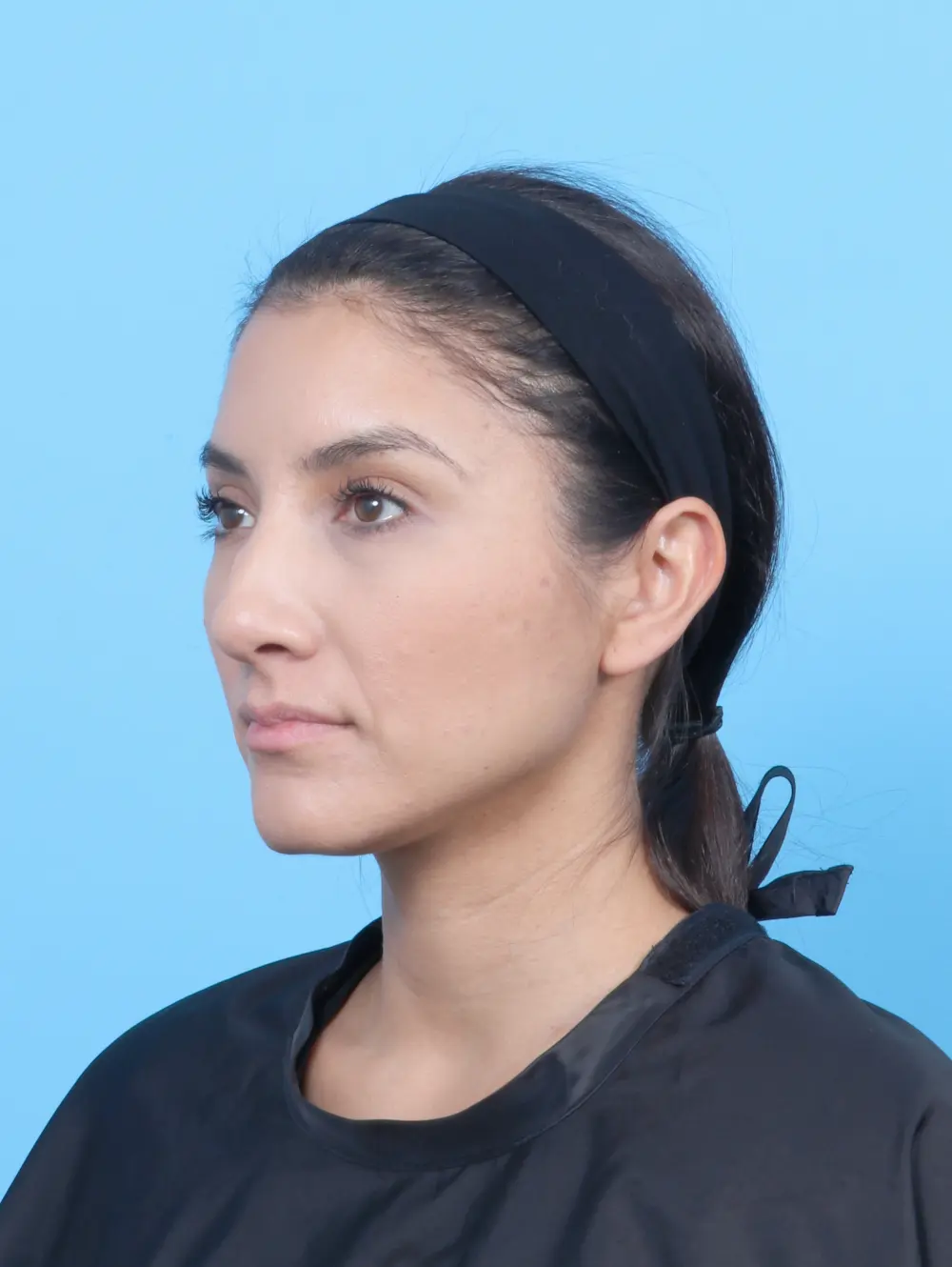 Rhinoplasty Patient Photo - Case 53227 - before view-1
