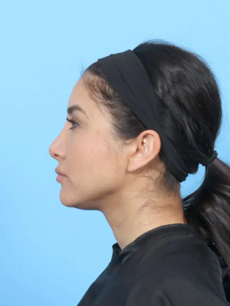 Rhinoplasty - Case 53227 - After