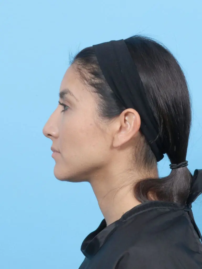 Rhinoplasty - Case 53227 - Before