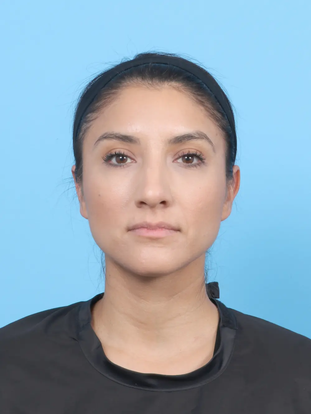 Rhinoplasty Patient Photo - Case 53227 - before view-2