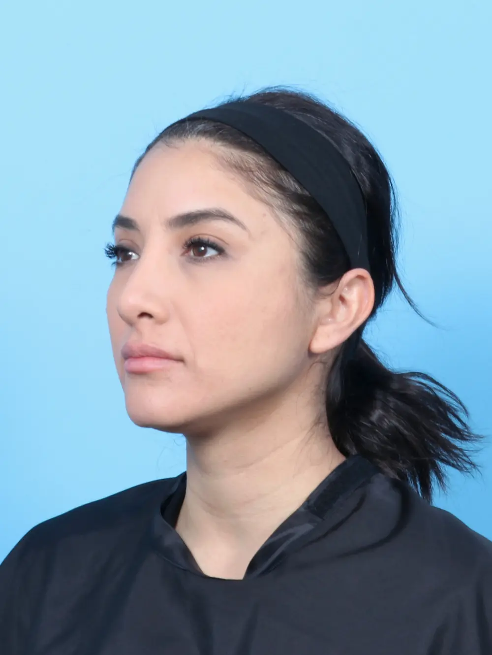 Rhinoplasty Patient Photo - Case 53227 - after view-1