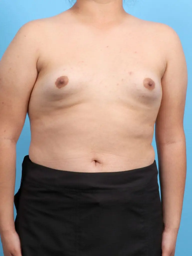 Breast Augmentation - Case 53229 - Before