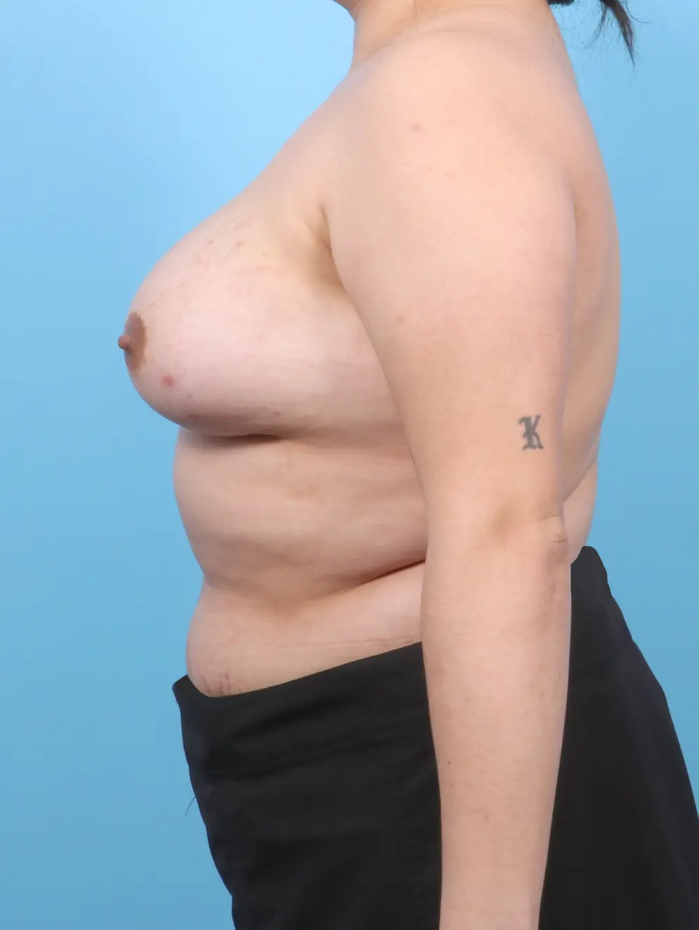 Breast Augmentation Patient Photo - Case 53229 - after view-2