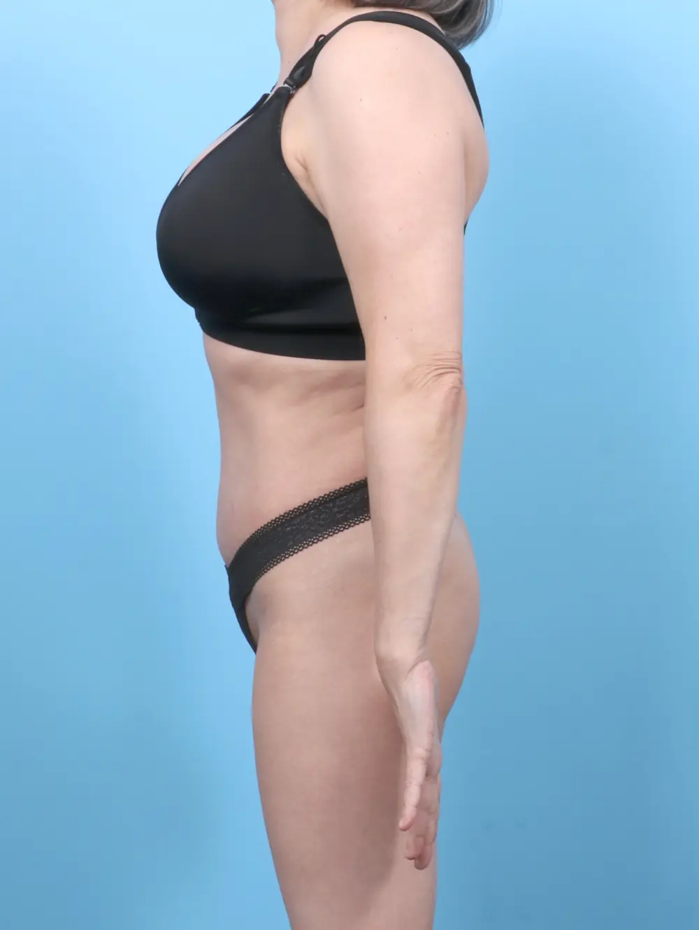 Tummy Tuck Patient Photo - Case 53248 - after view-2