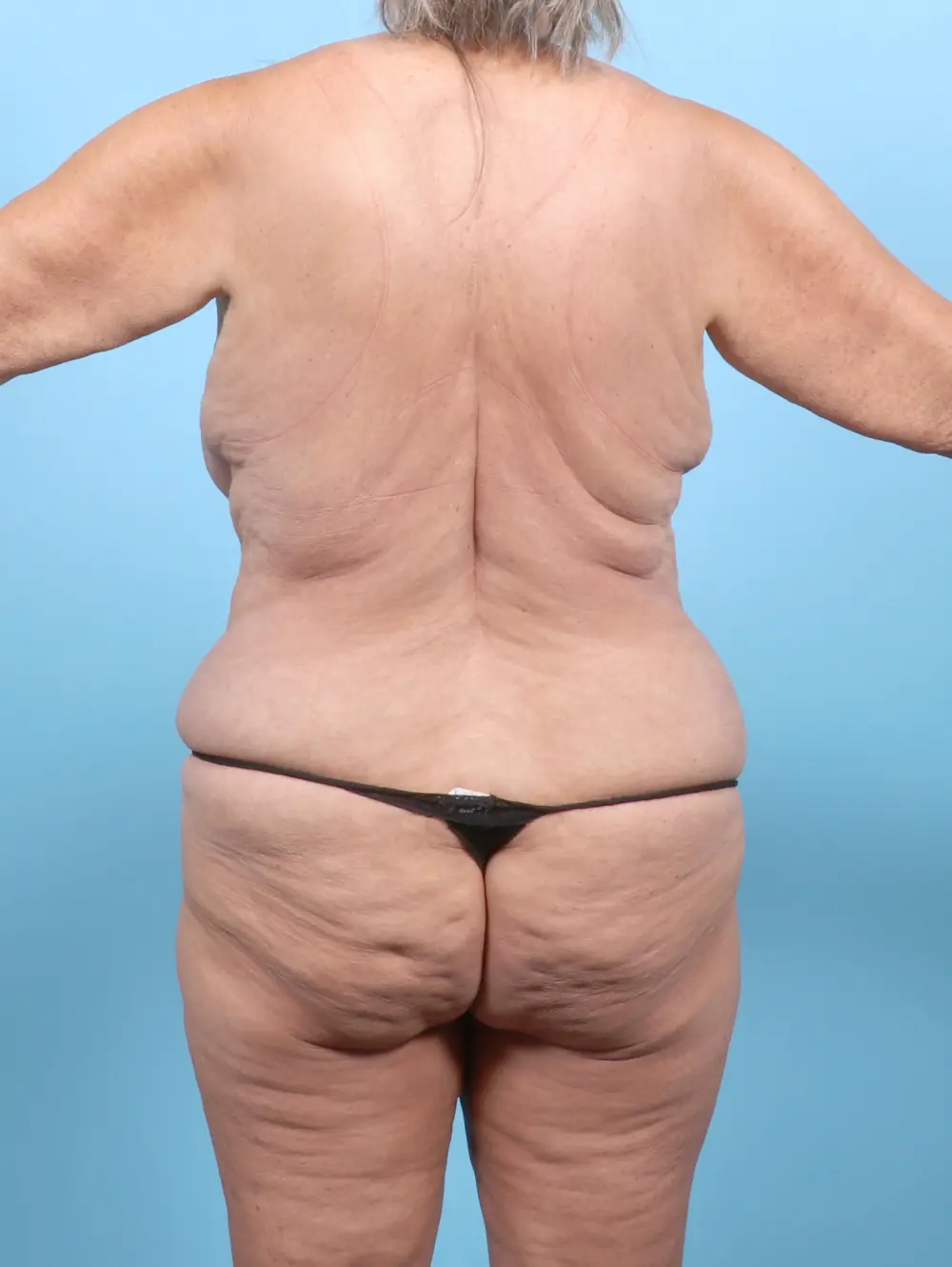 Tummy Tuck Patient Photo - Case 53265 - before view-3