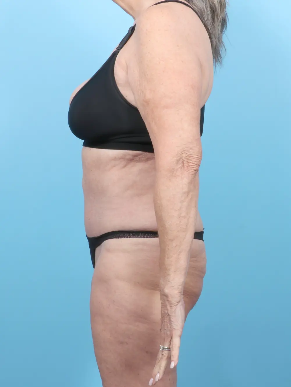 Tummy Tuck Patient Photo - Case 53265 - after view-2