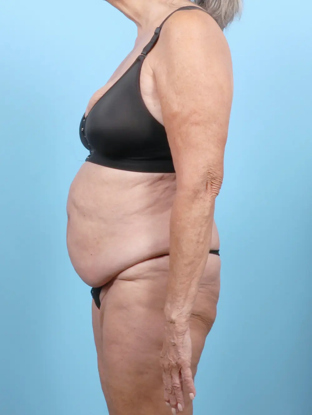 Tummy Tuck Patient Photo - Case 53265 - before view-2