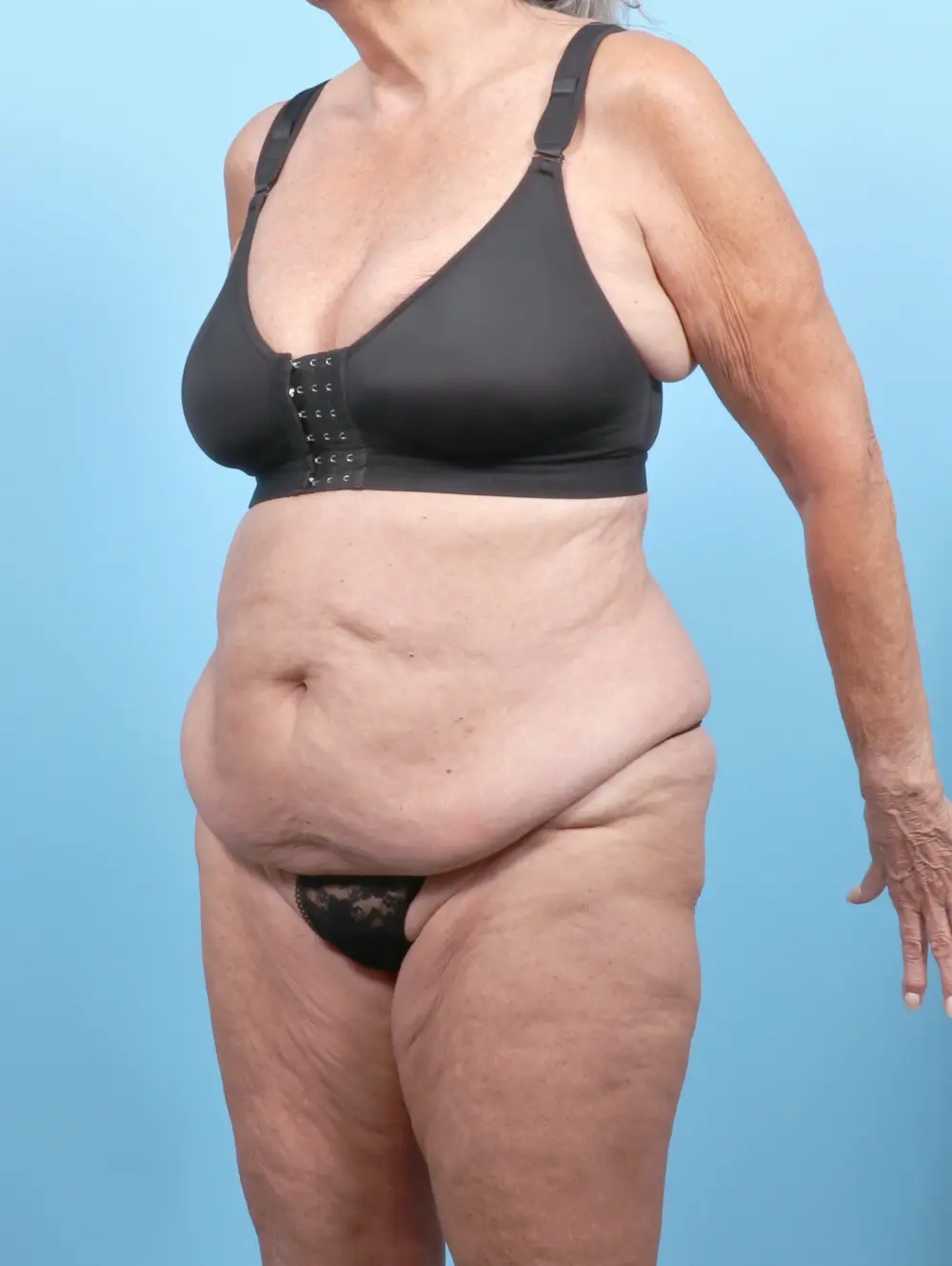 Tummy Tuck Patient Photo - Case 53265 - before view-1