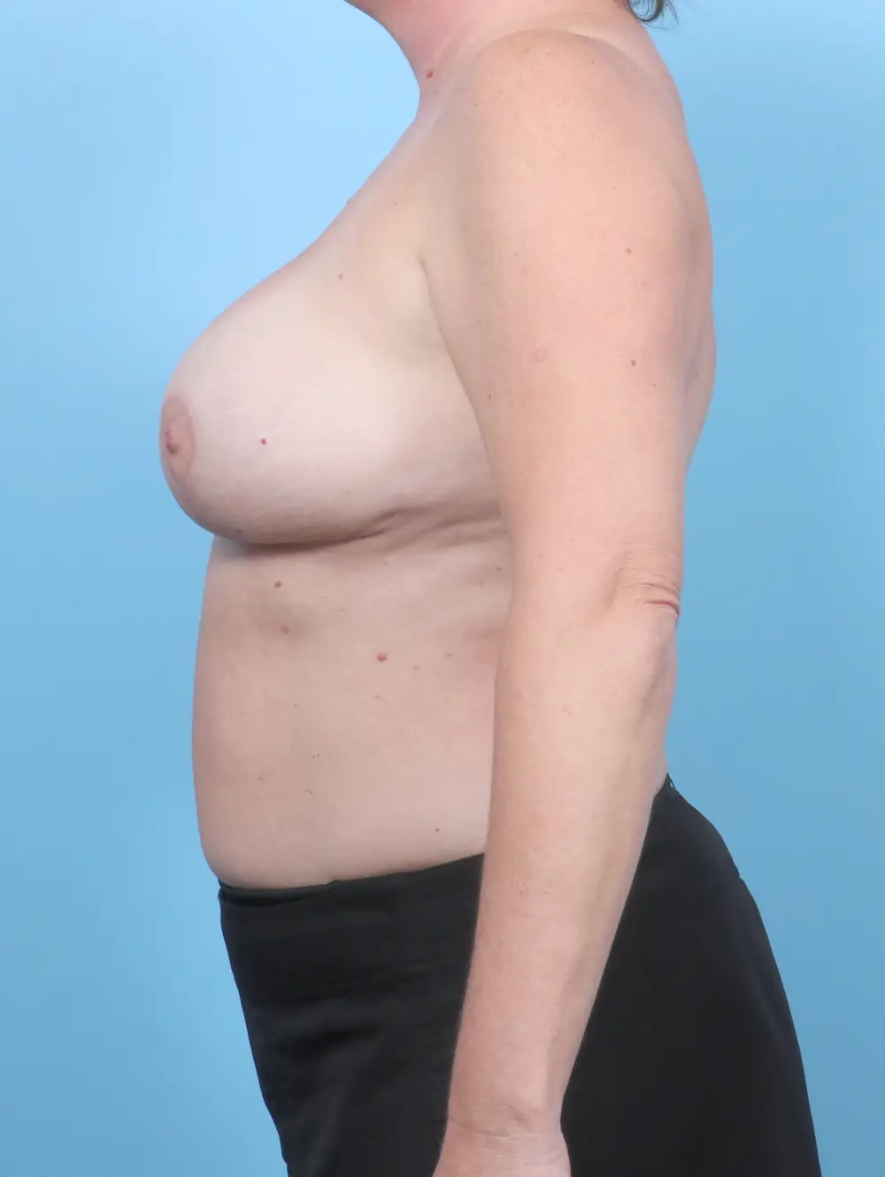 Breast Lift/Reduction with Implants Patient Photo - Case 53275 - after view-2
