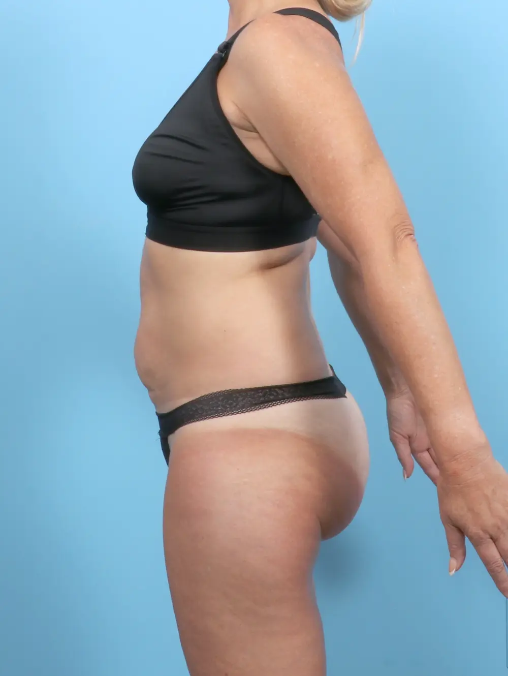 Tummy Tuck Patient Photo - Case 53291 - before view-2