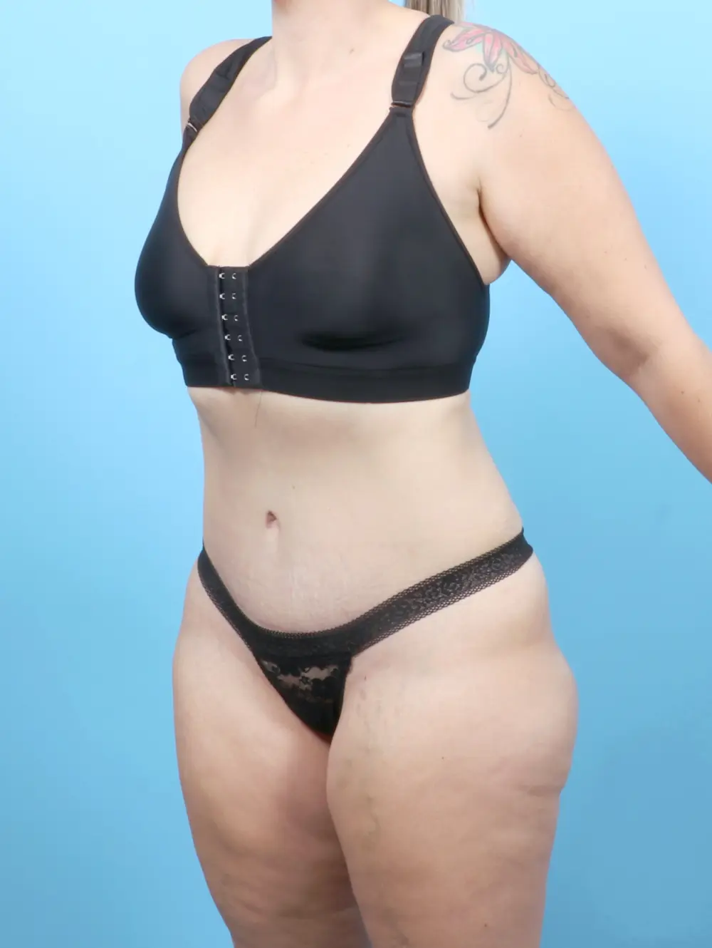 Tummy Tuck Patient Photo - Case 53299 - after view-1