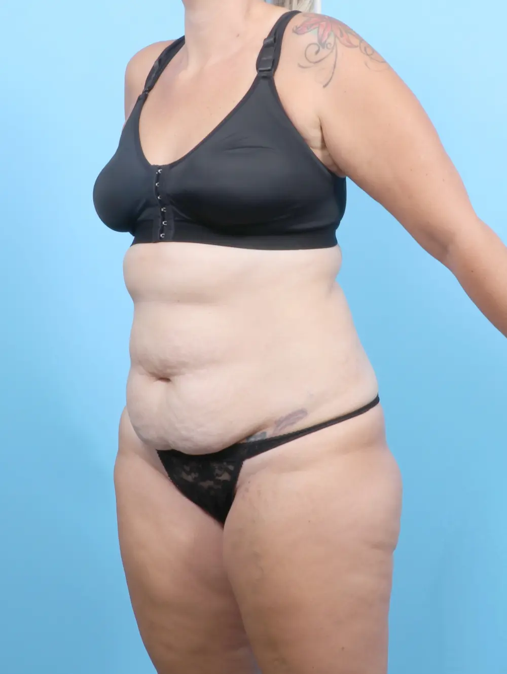 Tummy Tuck Patient Photo - Case 53299 - before view-1
