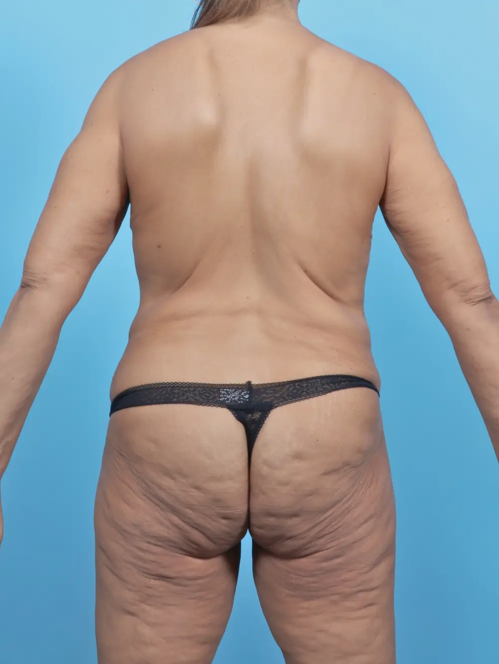 Body Lift Patient Photo - Case 53341 - before view-3