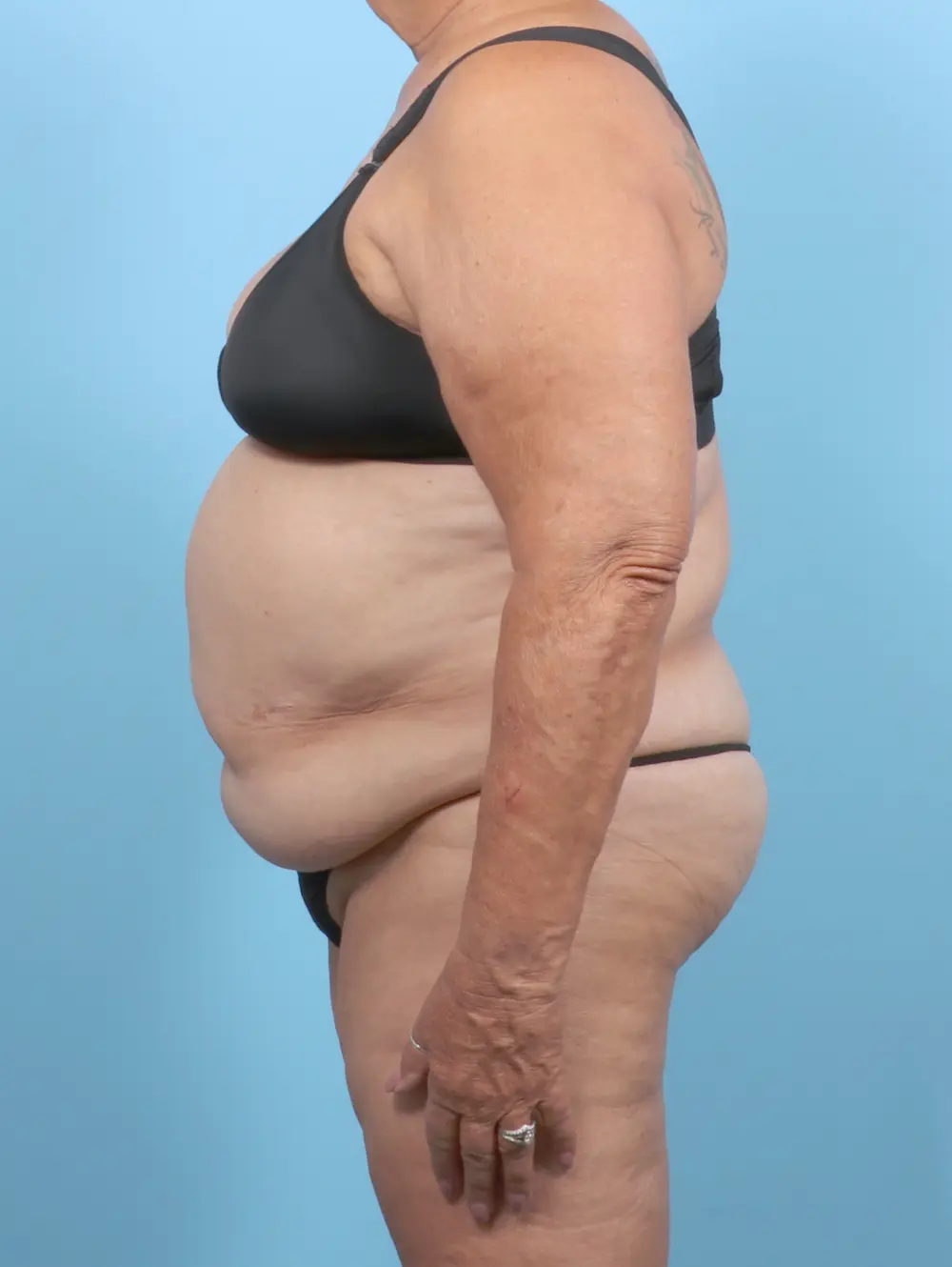 Tummy Tuck Patient Photo - Case 53375 - before view-2