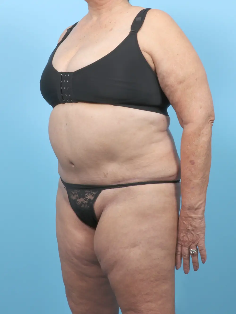 Tummy Tuck Patient Photo - Case 53375 - after view-1