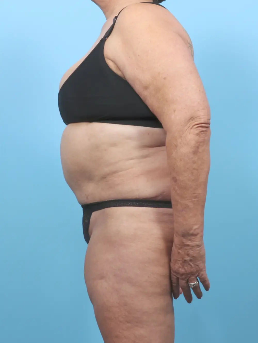 Tummy Tuck Patient Photo - Case 53375 - after view-2