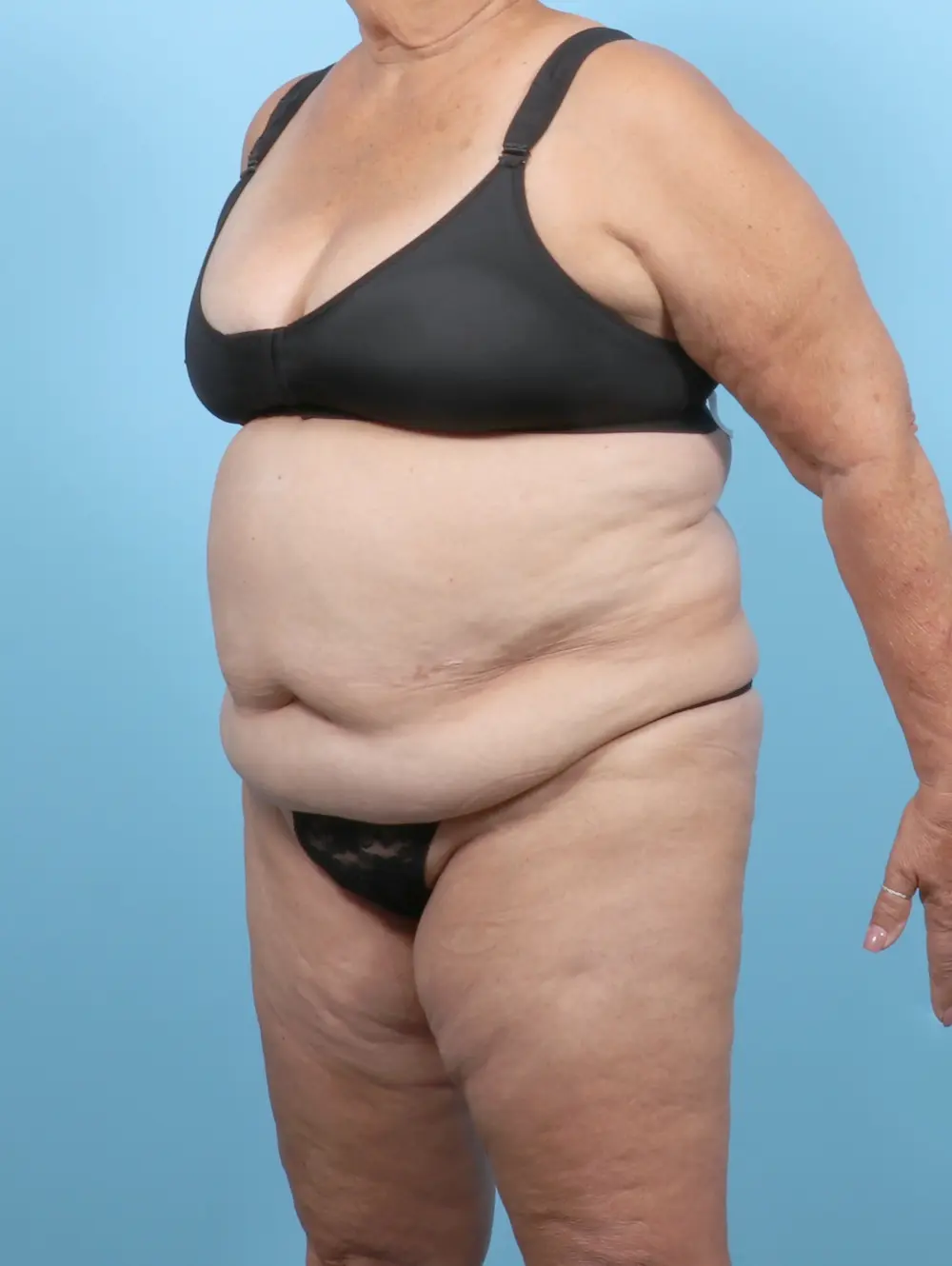 Tummy Tuck Patient Photo - Case 53375 - before view-1