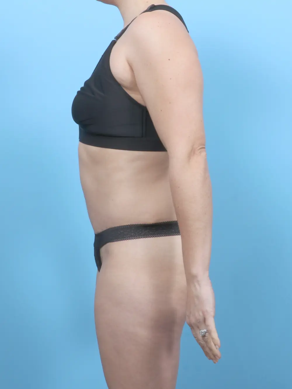 Tummy Tuck Patient Photo - Case 53385 - after view-2