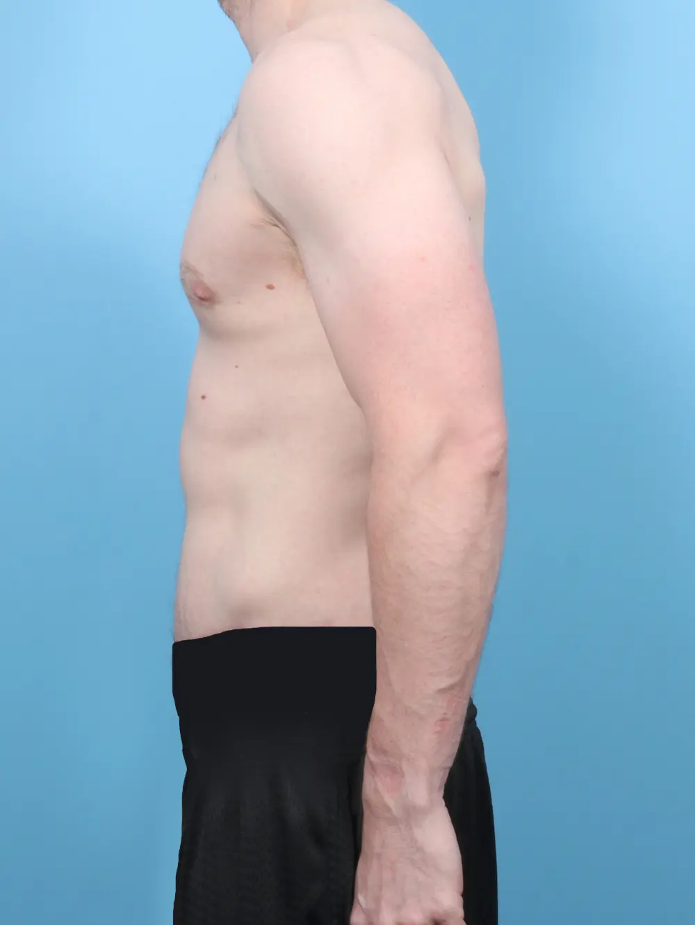 After Weight Loss Patient Photo - Case 53417 - after view-2