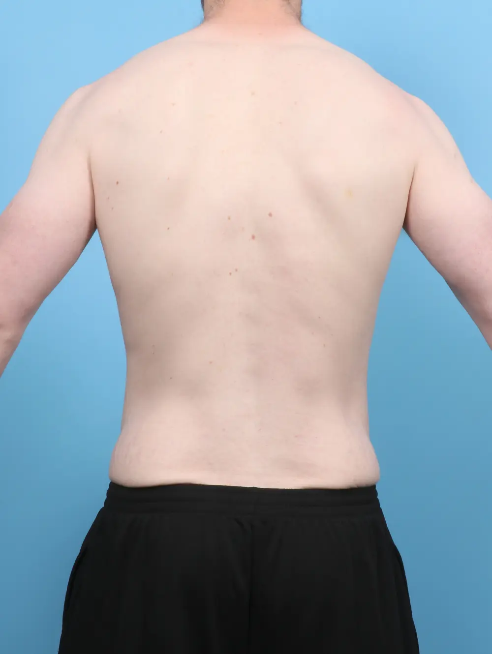 After Weight Loss Patient Photo - Case 53417 - before view-3