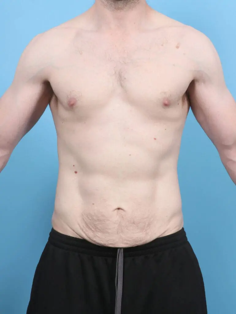 After Weight Loss - Case 53417 - Before