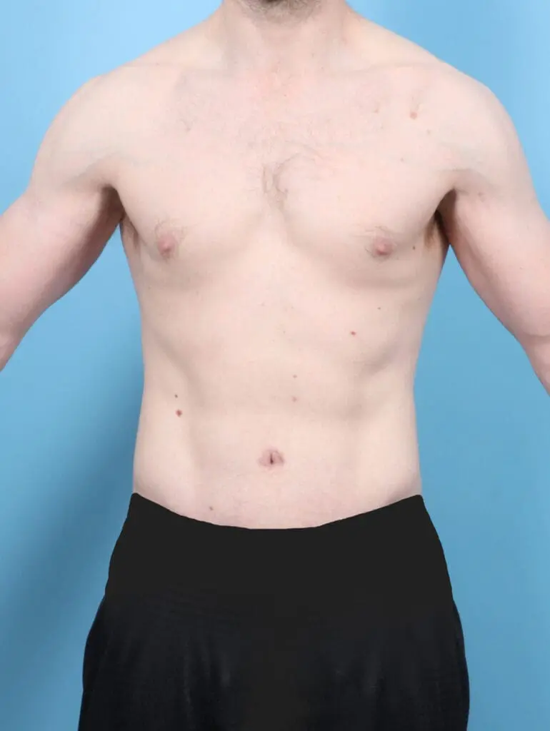 After Weight Loss - Case 53417 - After