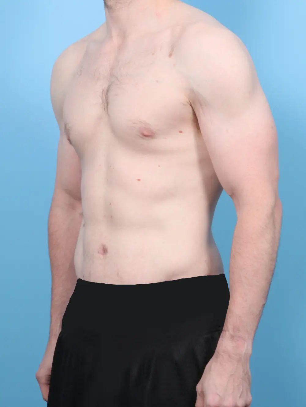 After Weight Loss Patient Photo - Case 53417 - after view-1