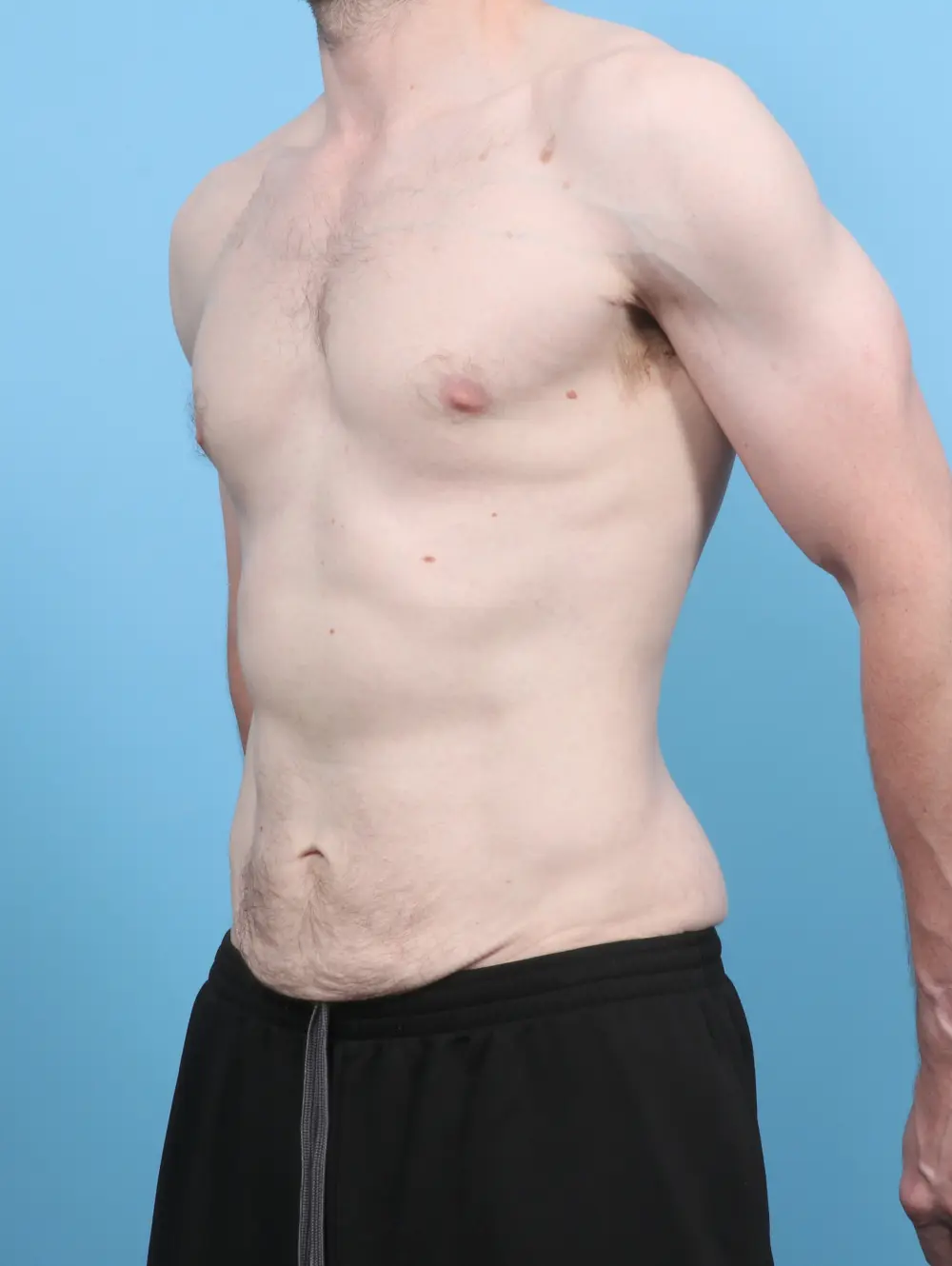 After Weight Loss Patient Photo - Case 53417 - before view-1