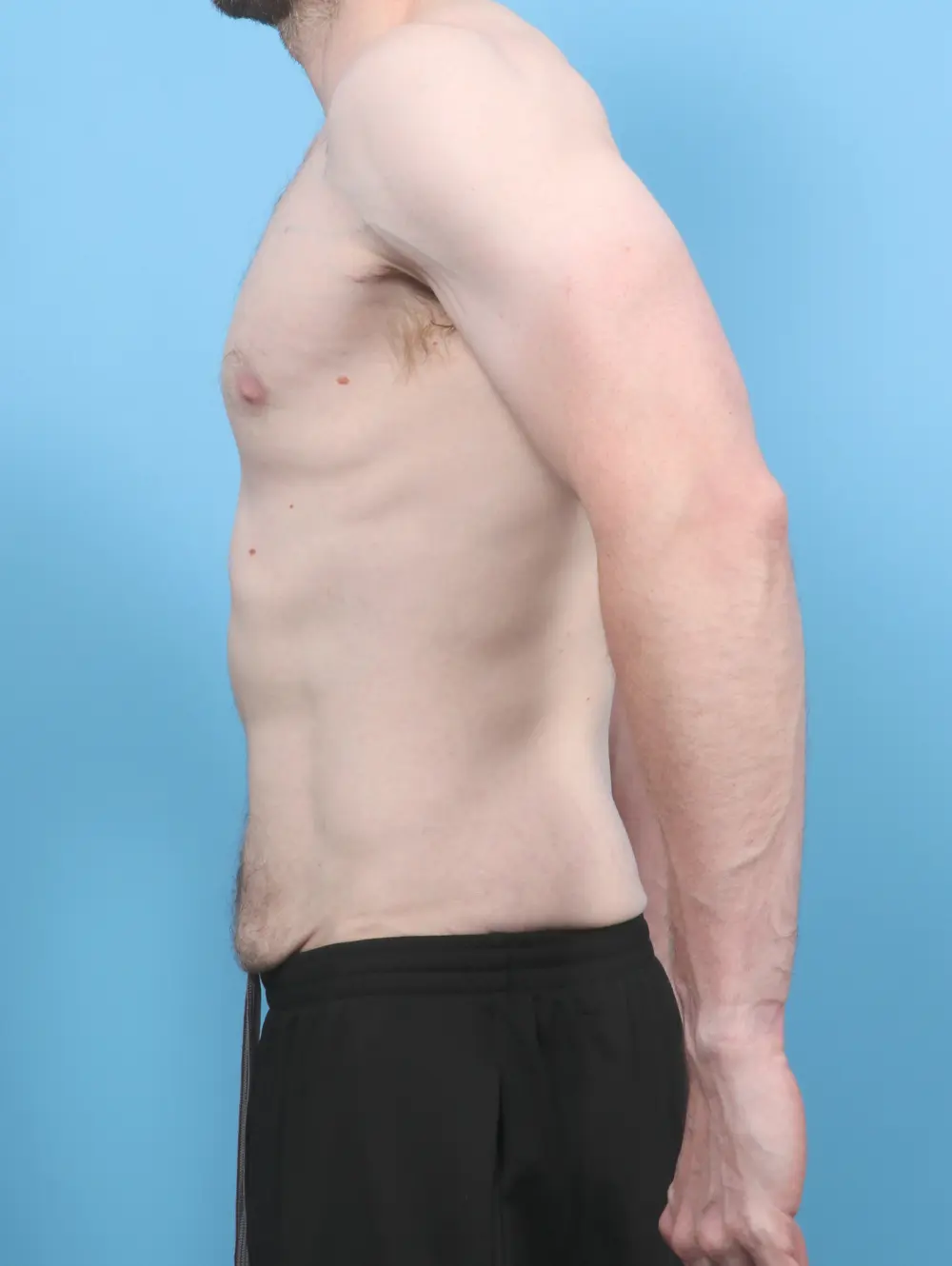 After Weight Loss Patient Photo - Case 53417 - before view-2