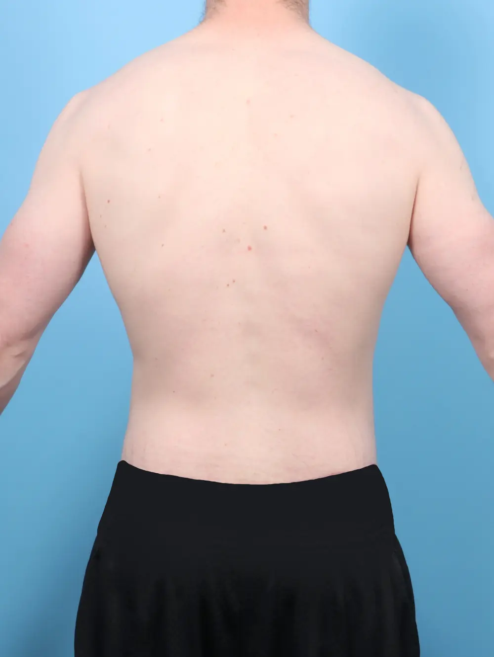 After Weight Loss Patient Photo - Case 53417 - after view-3