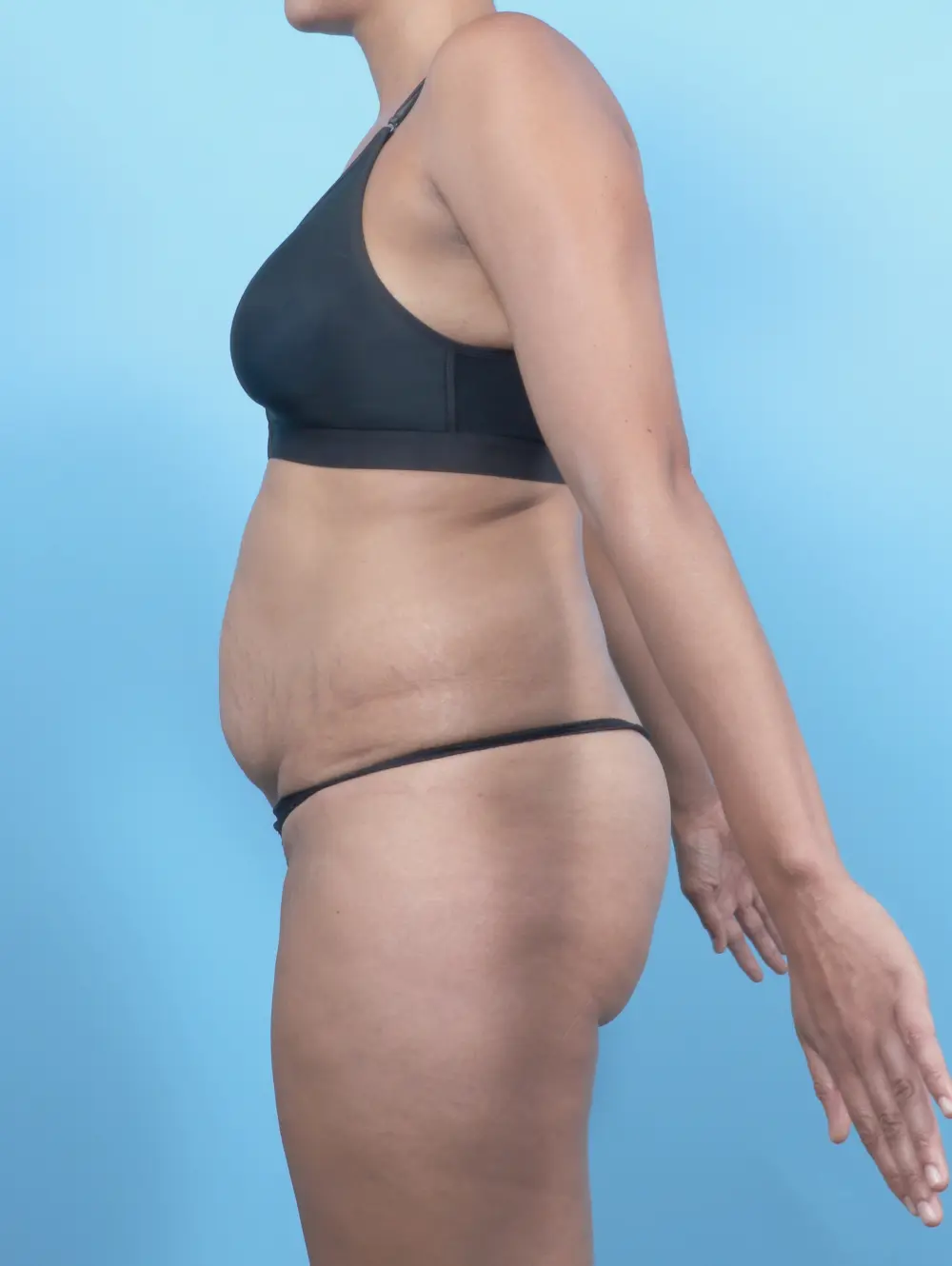 Tummy Tuck Patient Photo - Case 53435 - before view-2