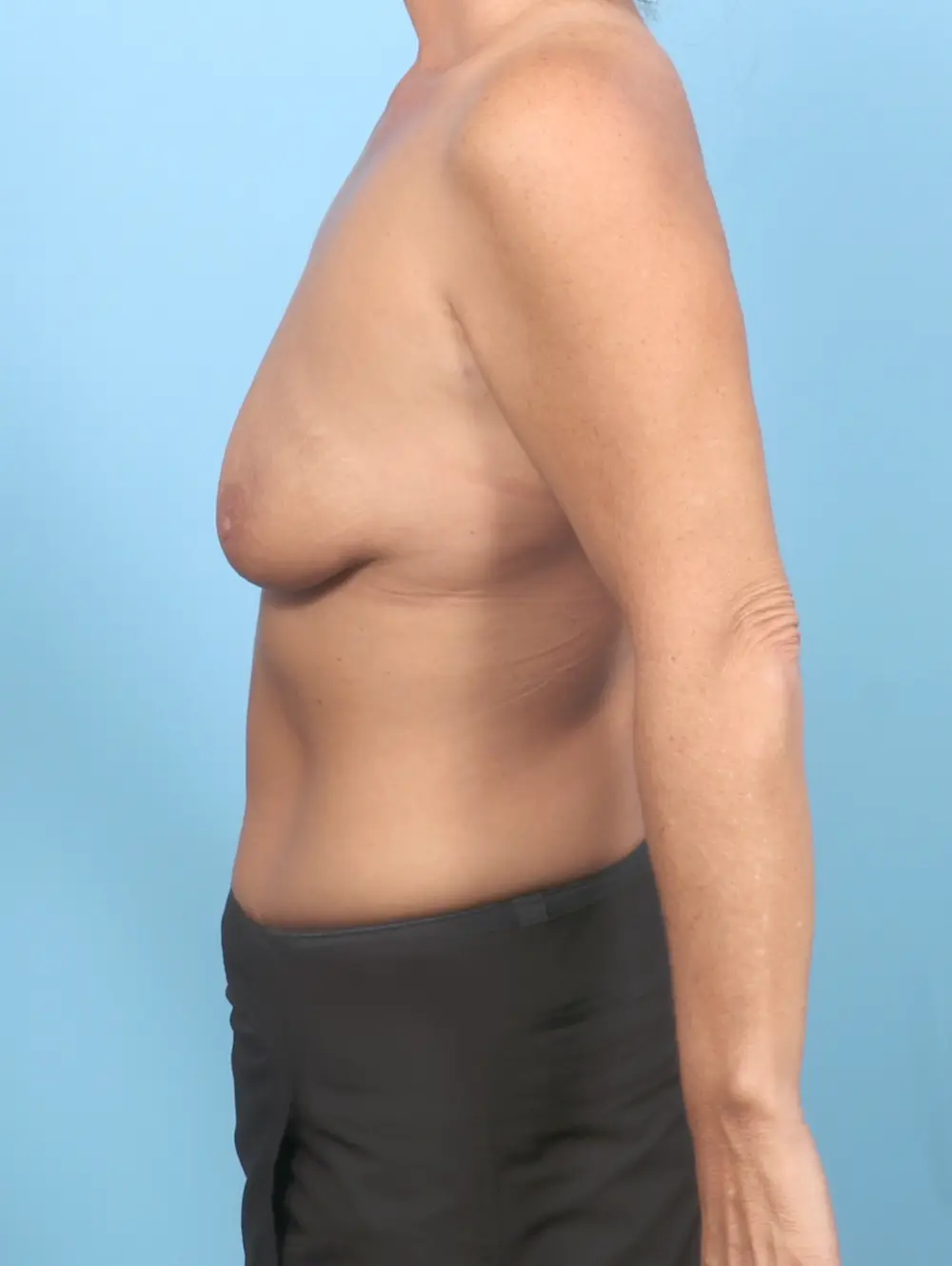 Breast Lift/Reduction with Implants Patient Photo - Case 53521 - before view-2