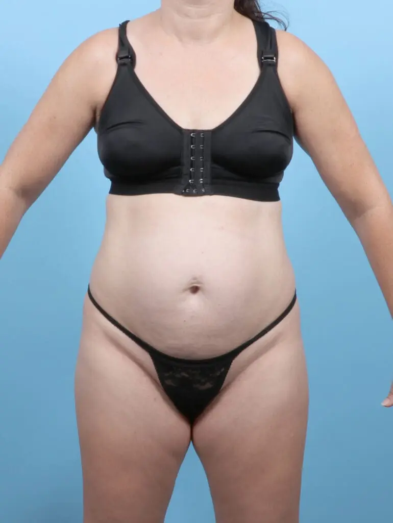 Tummy Tuck - Case 53529 - Before