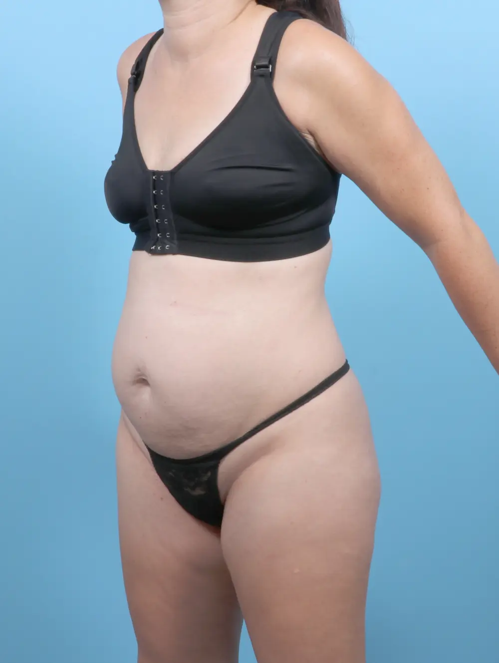Tummy Tuck Patient Photo - Case 53529 - before view-1