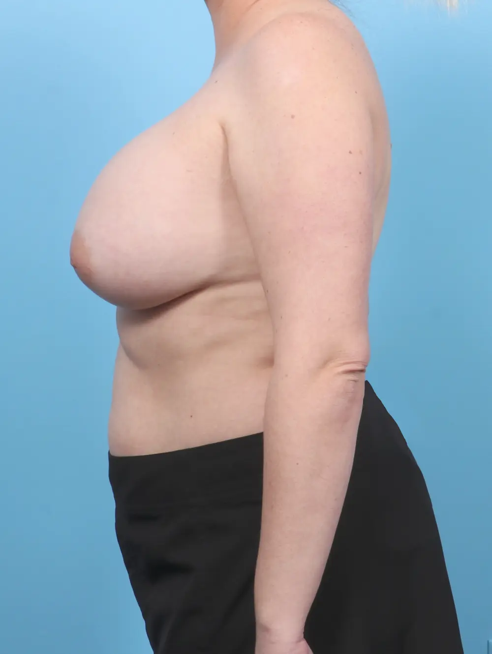 Breast Augmentation Patient Photo - Case 53537 - after view-2