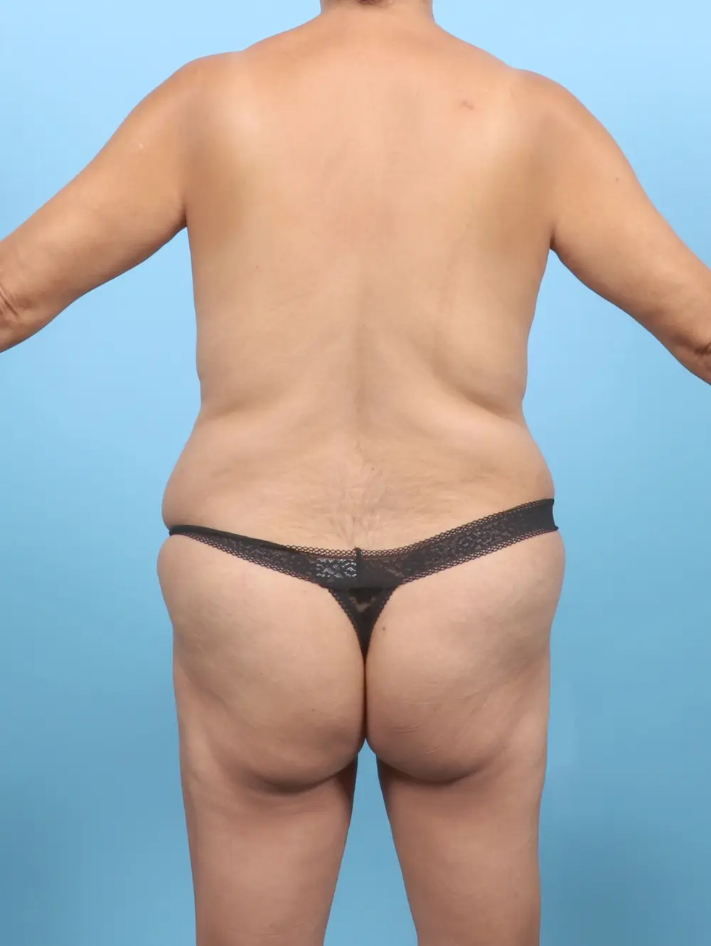 Tummy Tuck Patient Photo - Case 53553 - before view-3