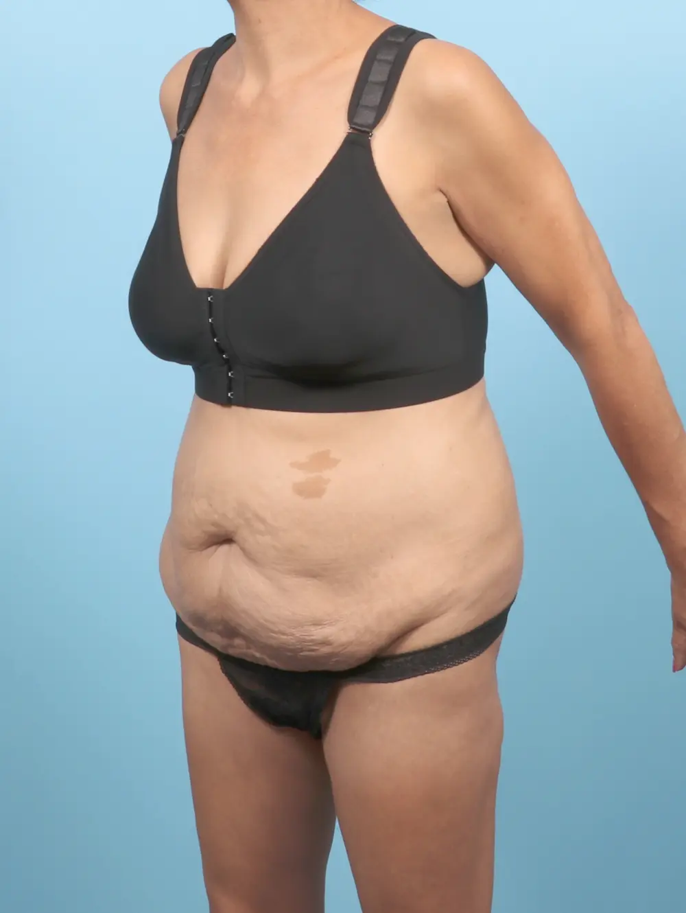 Tummy Tuck Patient Photo - Case 53553 - before view-1