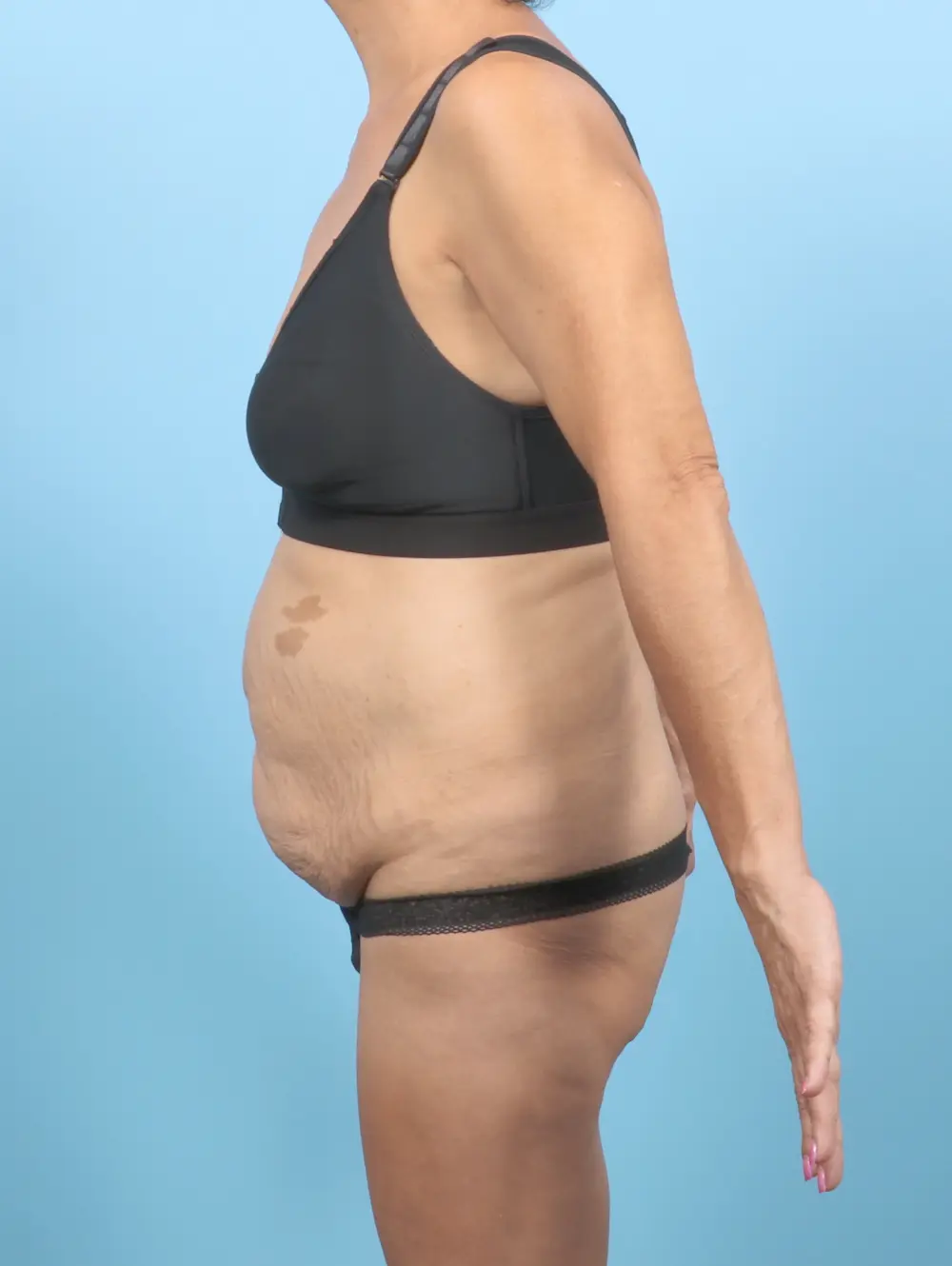 Tummy Tuck Patient Photo - Case 53553 - before view-2