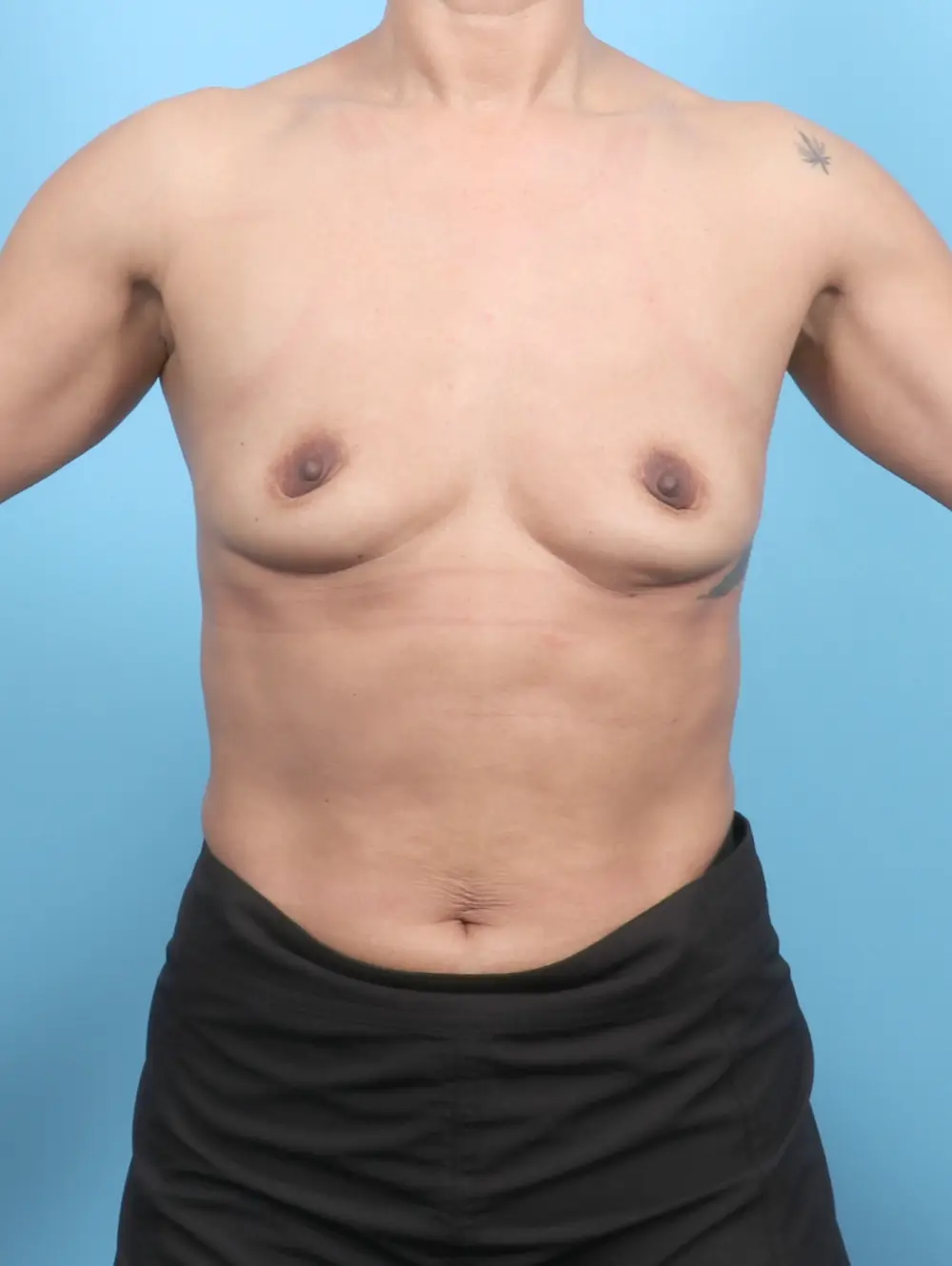 Breast Augmentation Patient Photo - Case 53579 - before view-