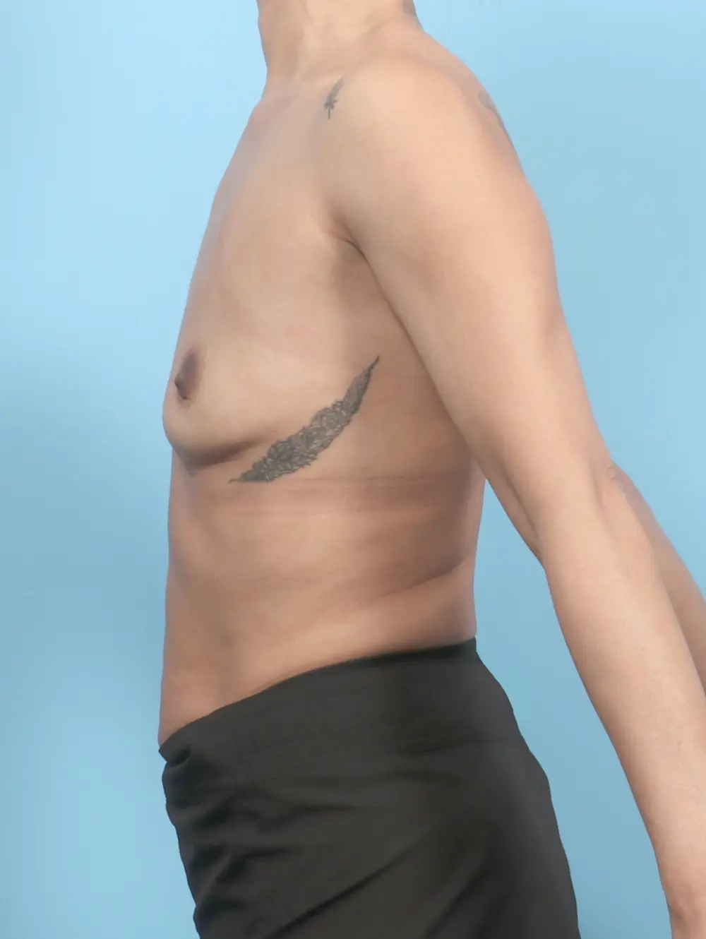 Breast Augmentation Patient Photo - Case 53579 - before view-2