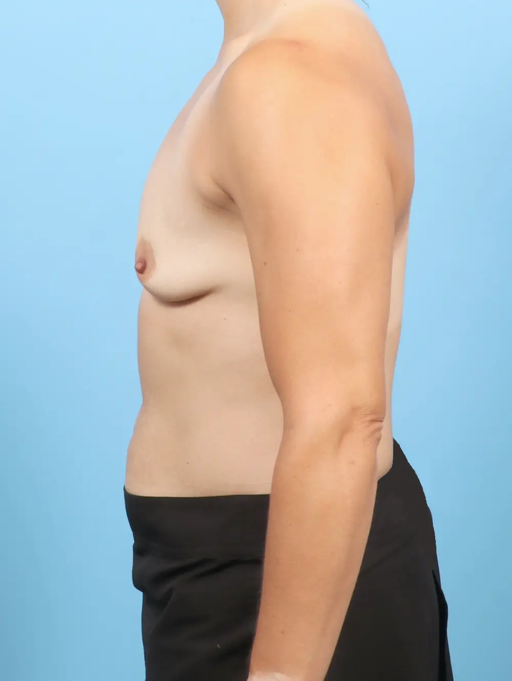 Breast Augmentation Patient Photo - Case 53595 - before view-2