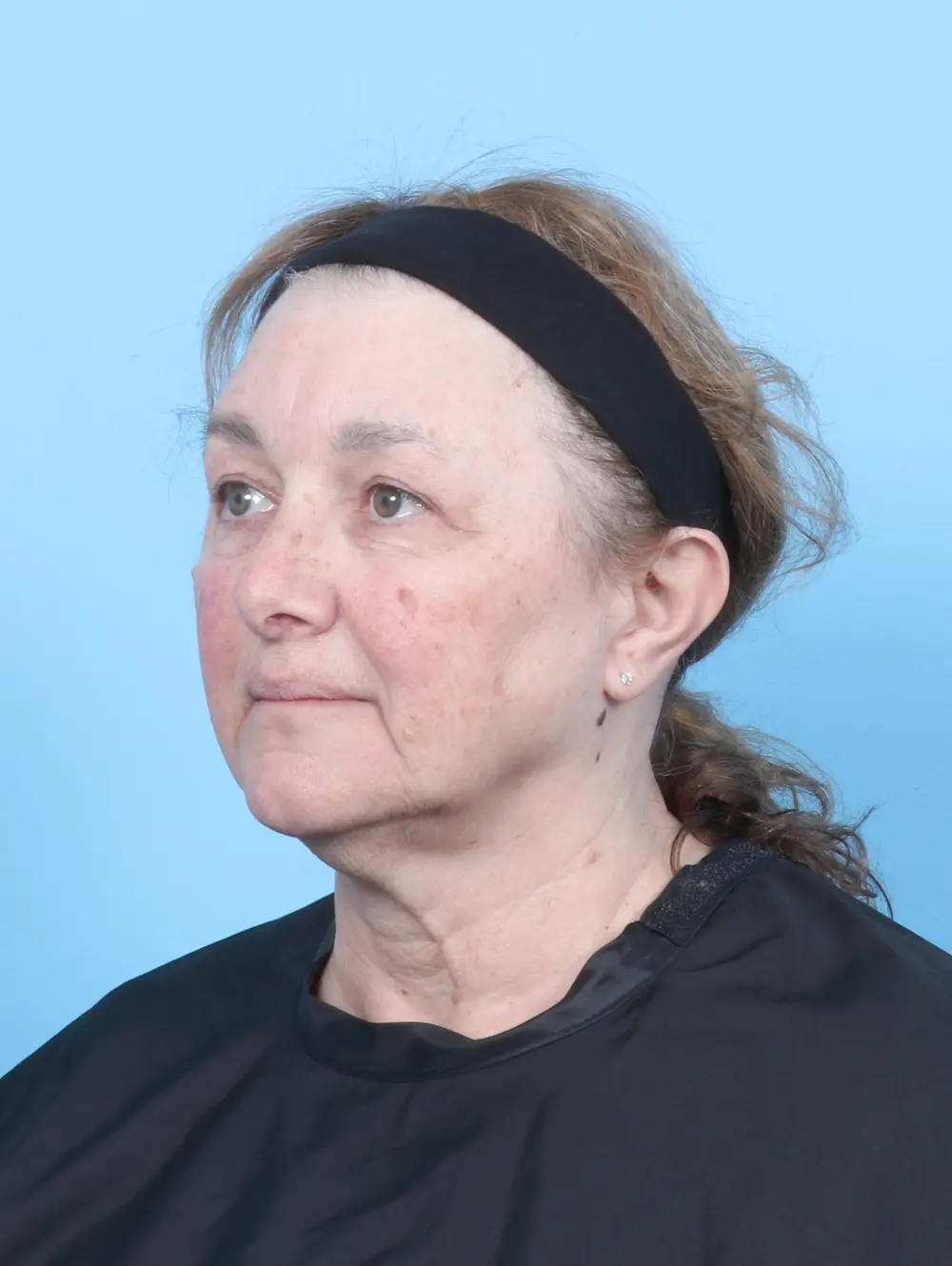 Brow Lift Patient Photo - Case 53603 - after view-1