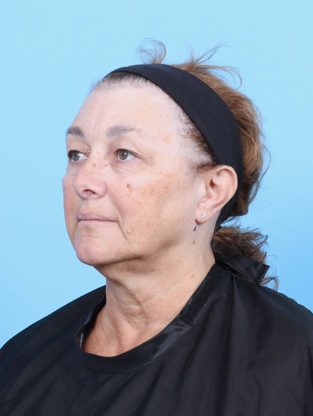 Brow Lift Patient Photo - Case 53603 - before view-1