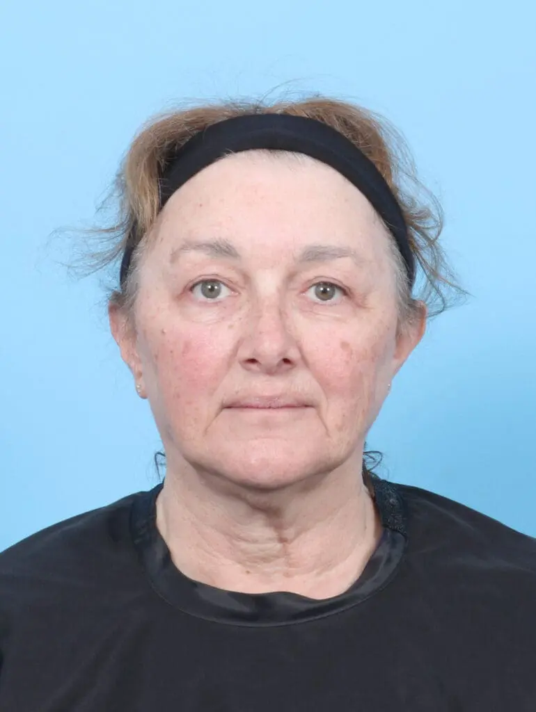 Brow Lift - Case 53603 - After