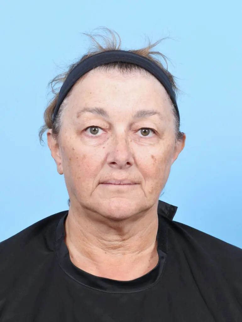 Brow Lift - Case 53603 - Before