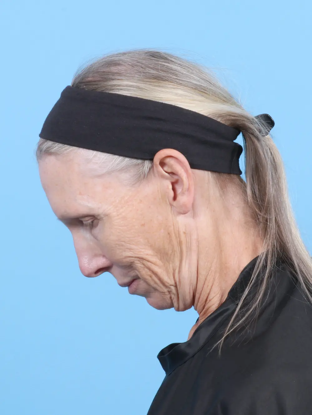 Eyelid Surgery Patient Photo - Case 53652 - before view-3