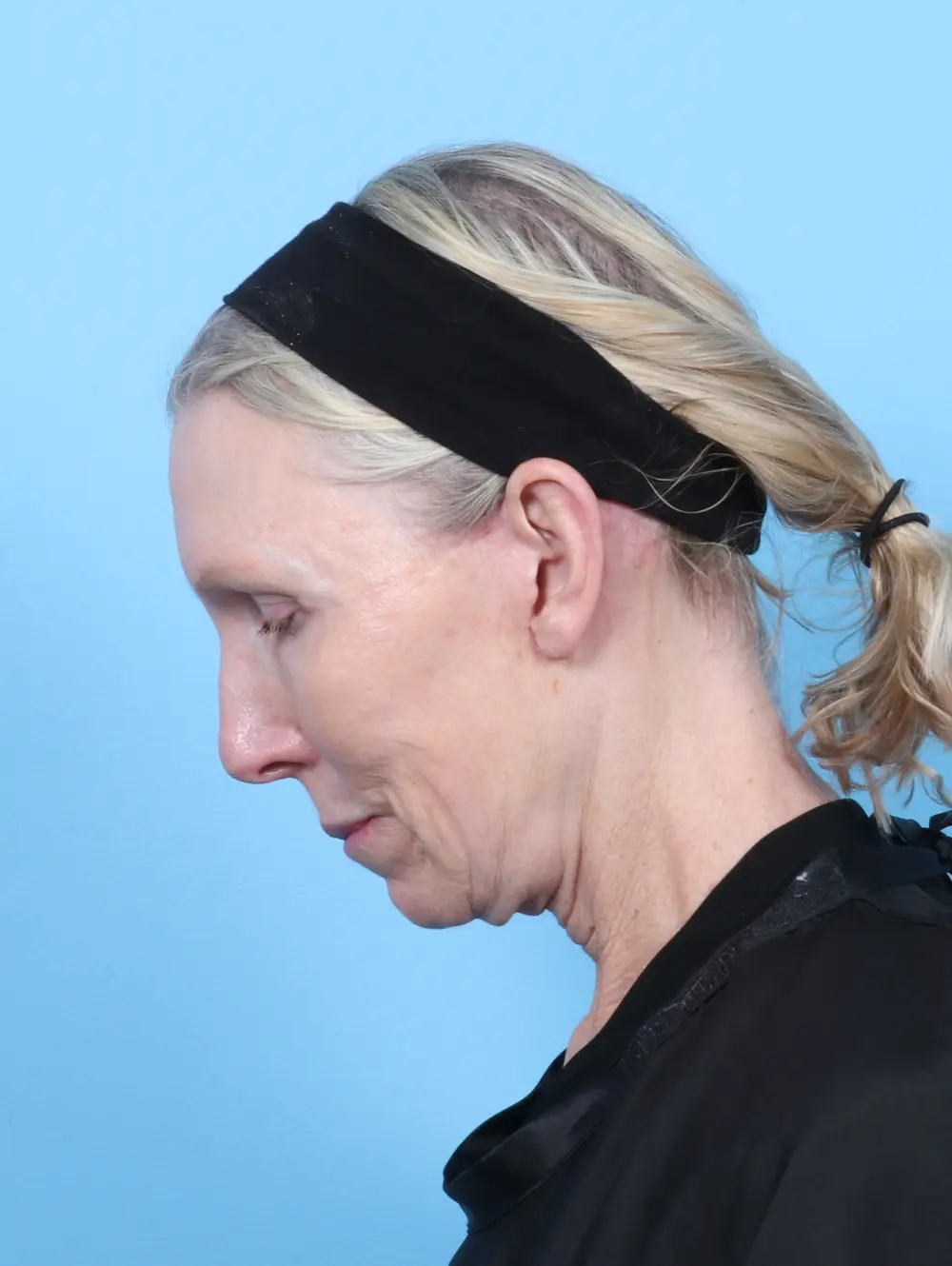 Eyelid Surgery Patient Photo - Case 53652 - after view-3