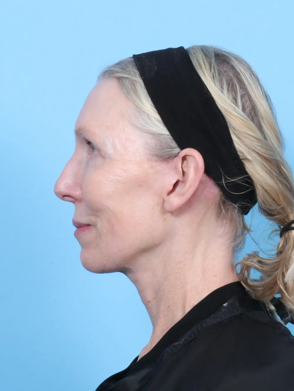 Eyelid Surgery Patient Photo - Case 53652 - after view-2