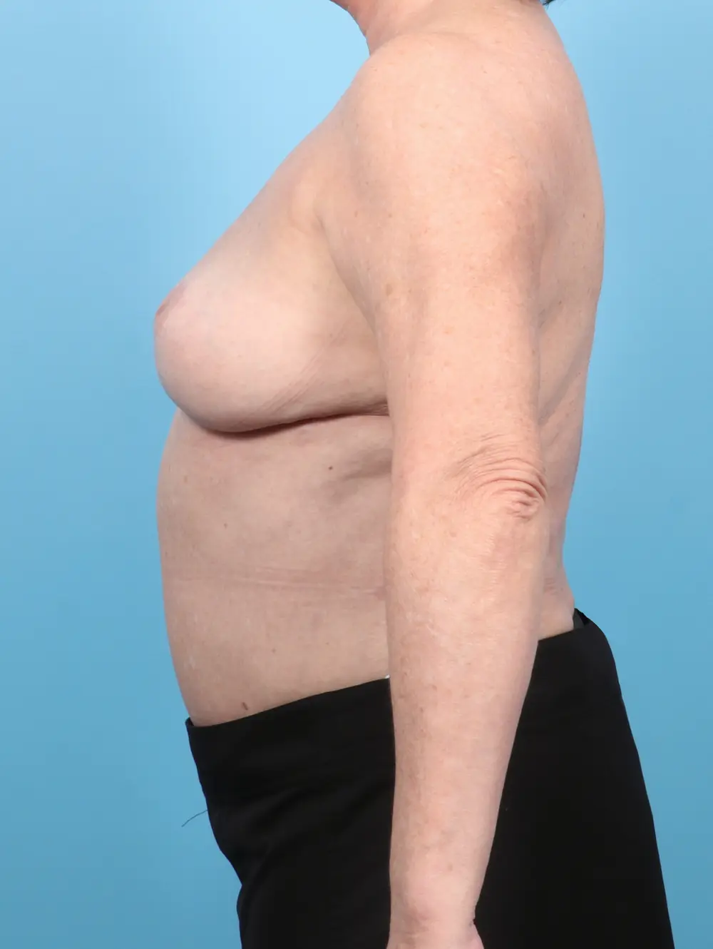 Breast Implant Removal Patient Photo - Case 53662 - after view-2